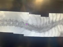 Zehn Stunden schneiden, hämmern und schrauben: Dane bekommt eine gerade Wirbelsäule