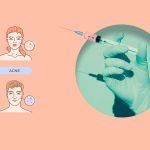 China Begins Clinical Trials of Its First Acne Vaccine