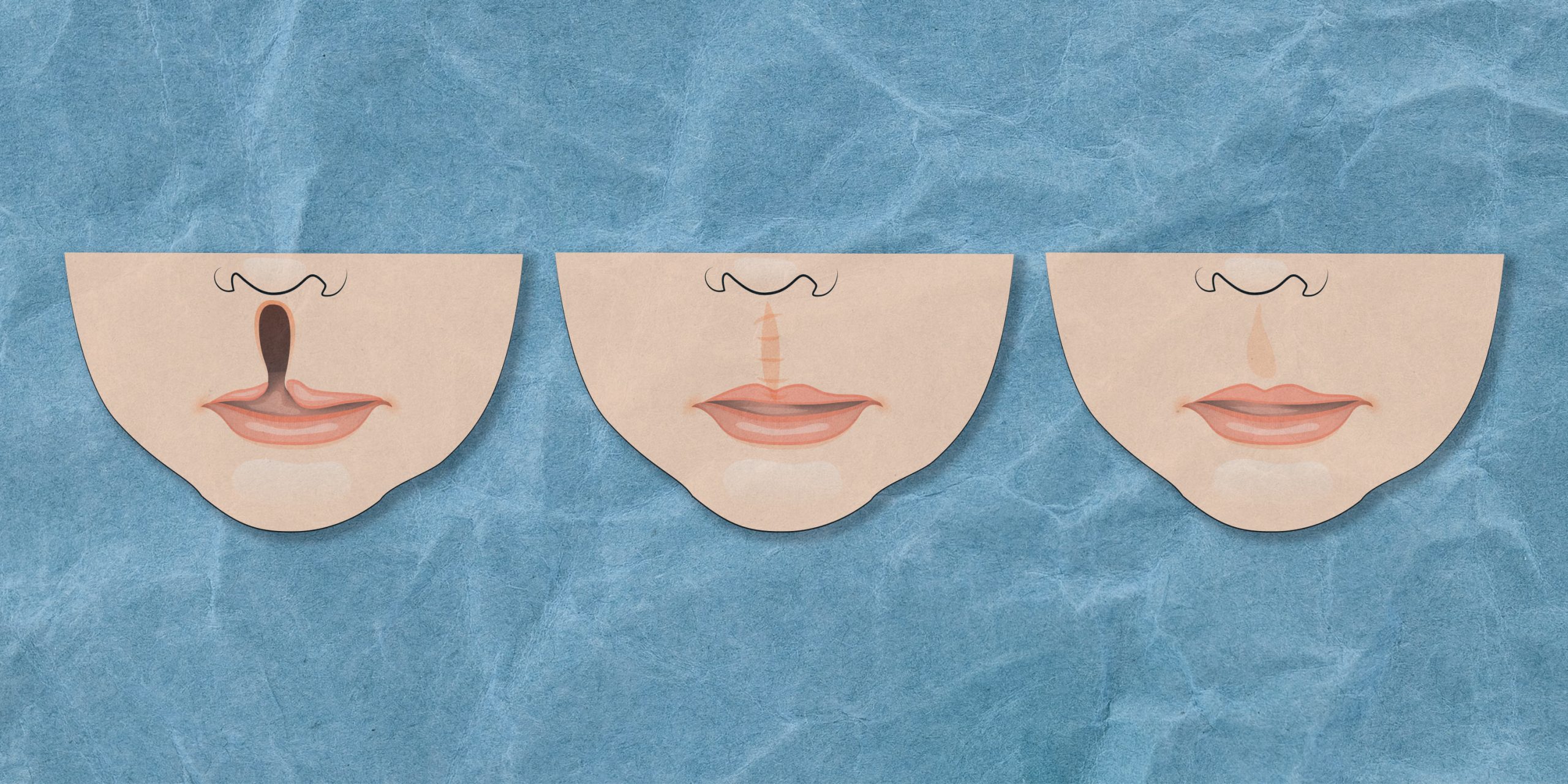 Cleft Lip: The Long Road to Repairing a Smile