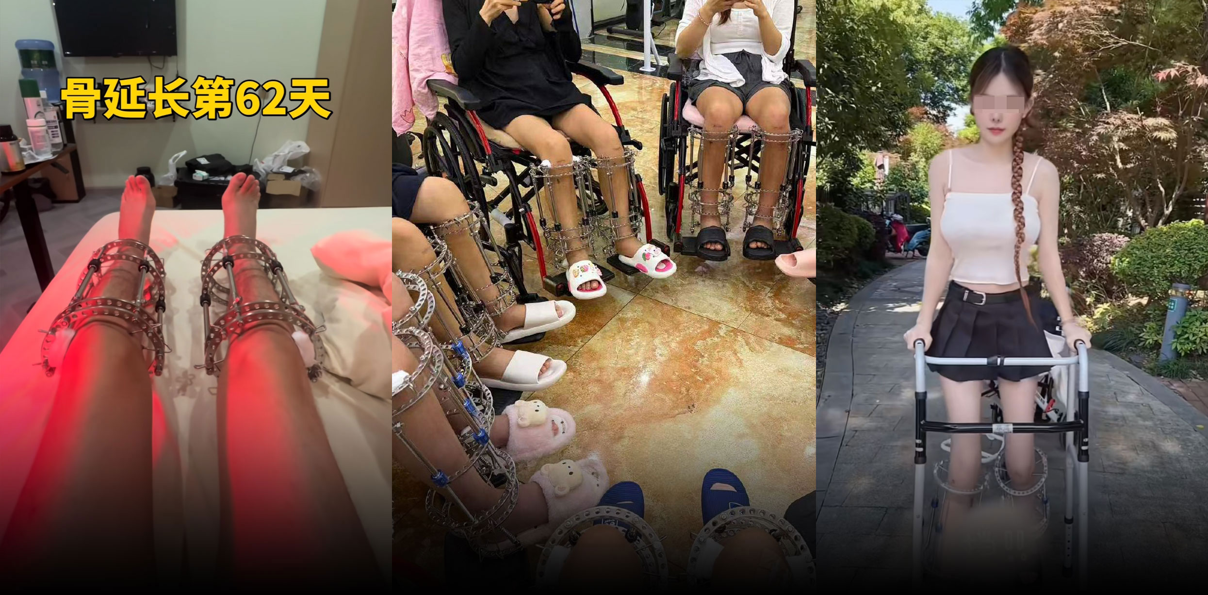 Investigation Uncovers China’s Underground Height Surgery Market